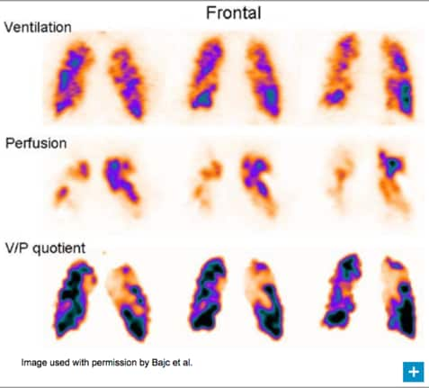 COPD scan image