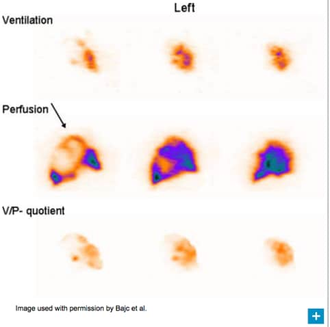 pneumonia scan image