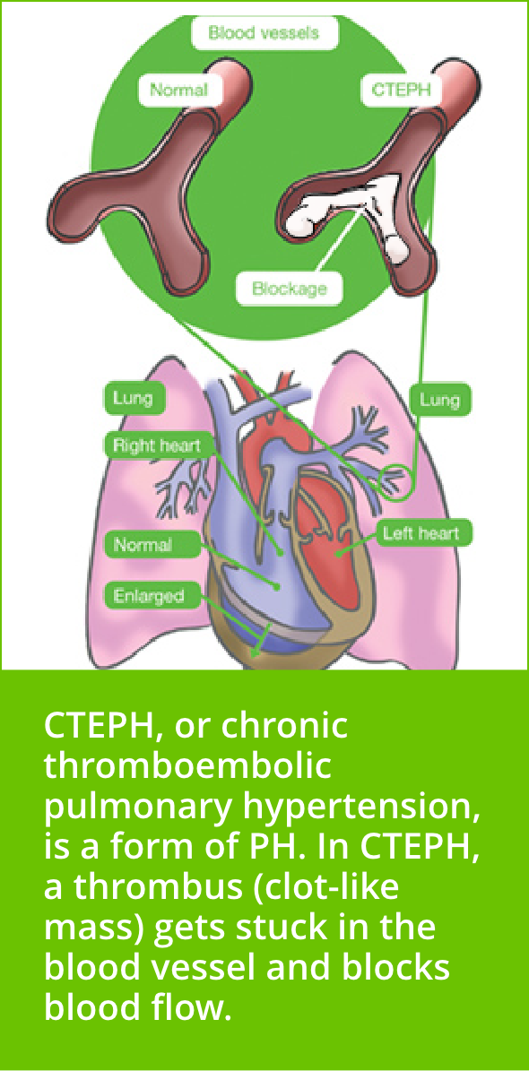 CTEPH Visualization CTEPH Visualization
