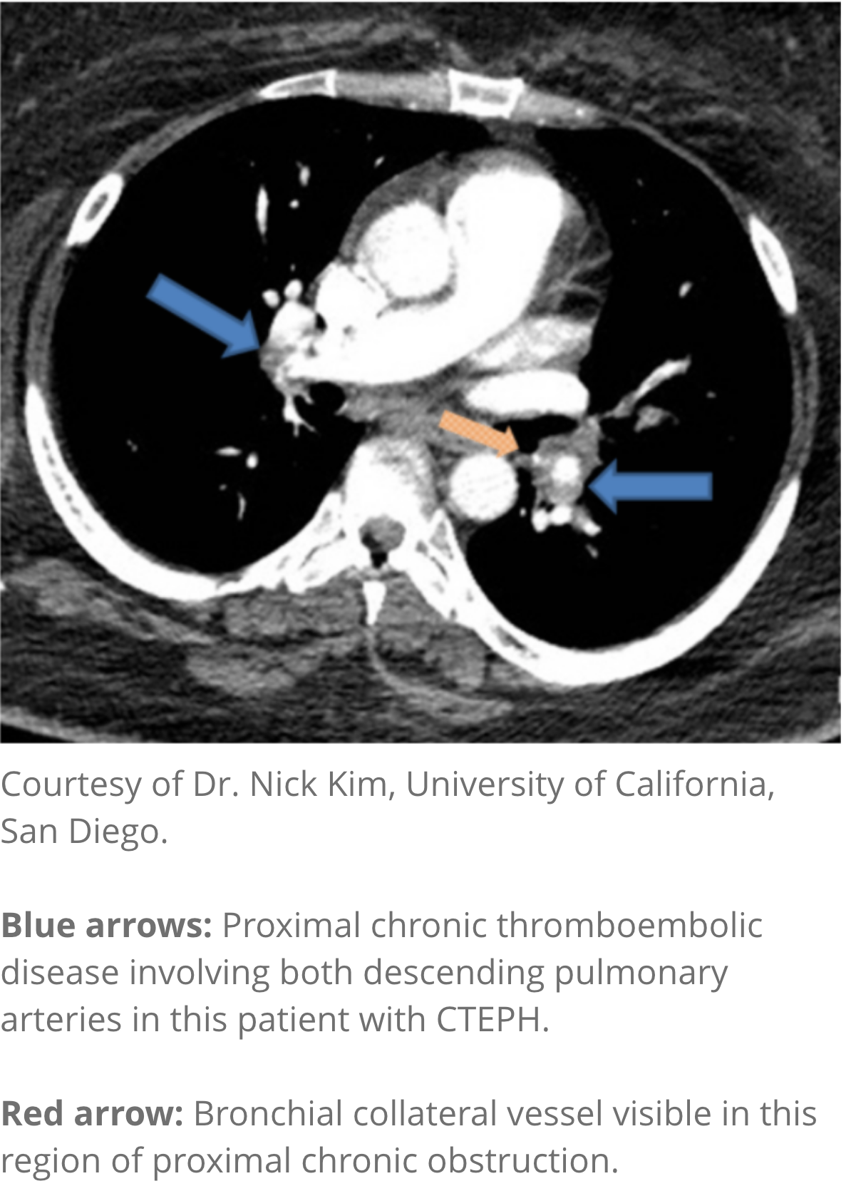 CT angiography image CT angiography image