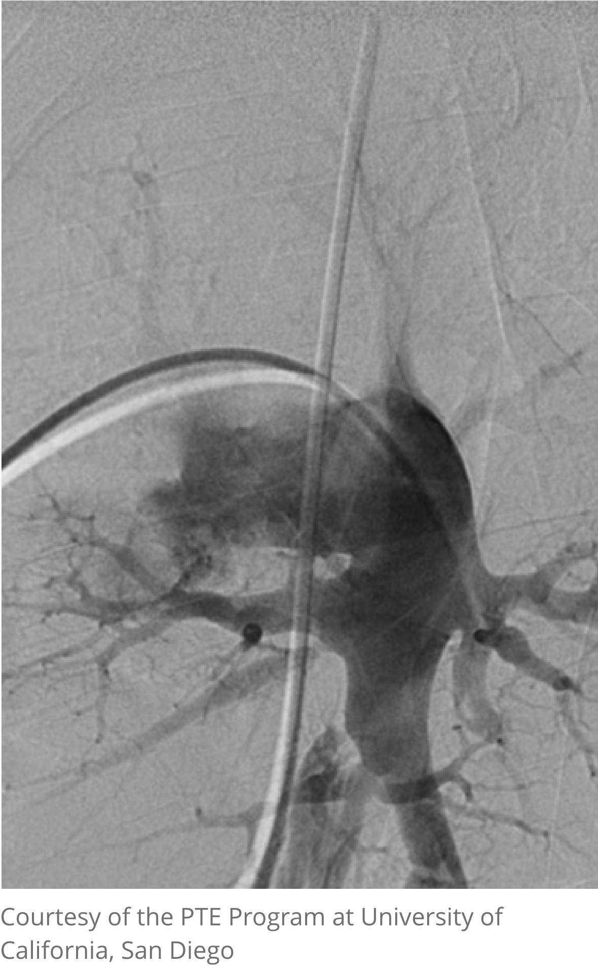 pulmonary angiography image pulmonary angiography image